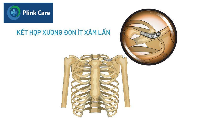 cố định ổ gãy xương