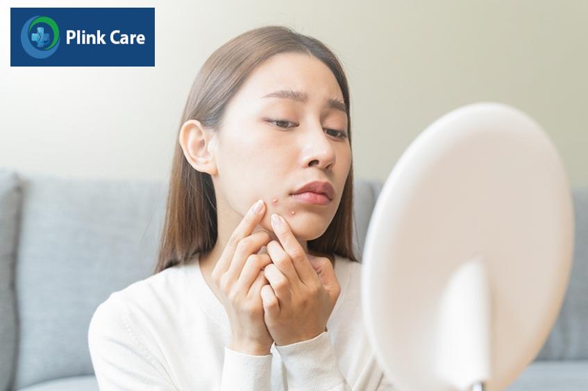 có nên nặn mụn trứng cá ở vùng cằm không