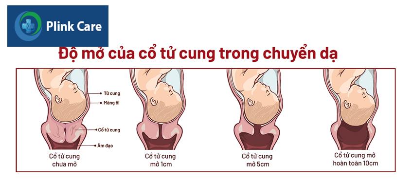 độ mở của tử cung trong chuyển dạ