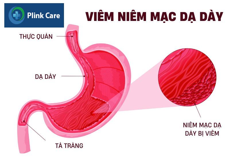 hình ảnh viêm niêm mạc dạ dày