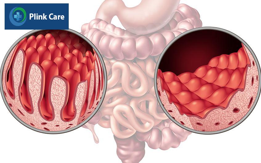 hội chứng rối loạn tiêu hóa