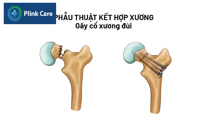 mổ kết hợp gãy cổ xương đùi