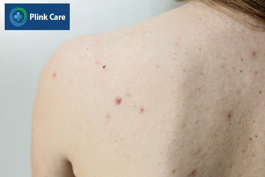 mụn trứng cá ở lưng là gì