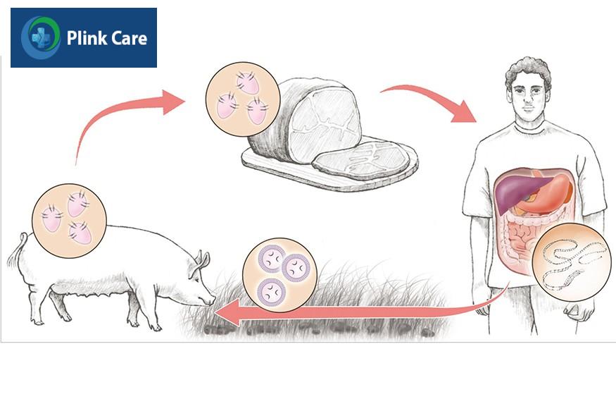 nguyên nhân gây bệnh sán lợn gạo