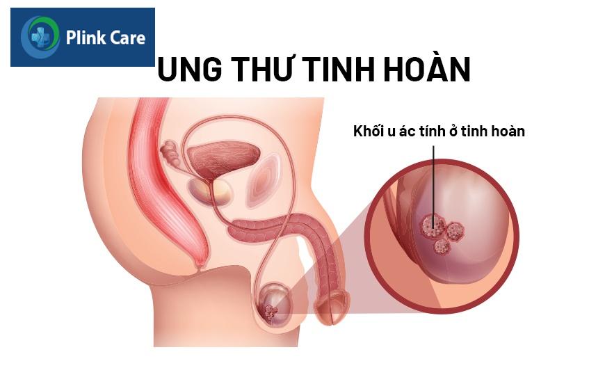 nguyên nhân gây đau tinh hoàn