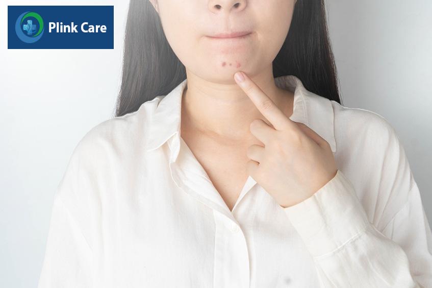 nguyên nhân gây mụn trứng cá ở cằm