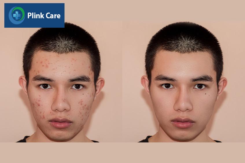 nguyên nhân gây ra mụn trứng cá