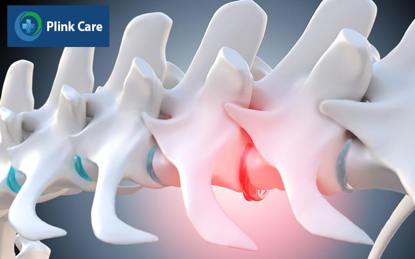 nguyên nhân khiến cột sống bị vôi hóa