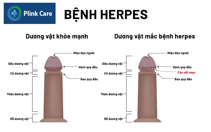 nguyên nhân nổi mụn ở bao quy đầu
