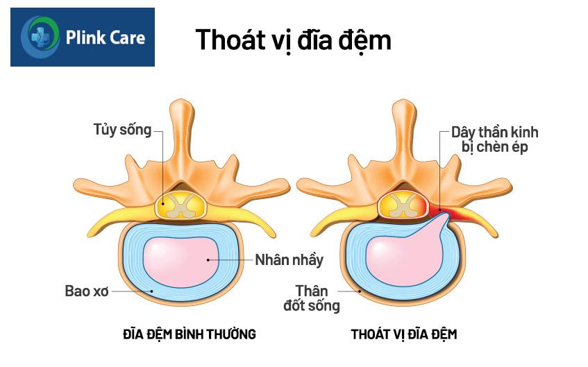 nhân nhầy đĩa đệm thoát ra khỏi vị trí ban đầu