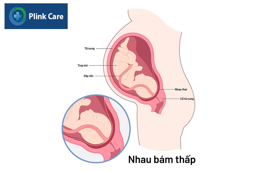 nhau cản đường ra của thai nhi