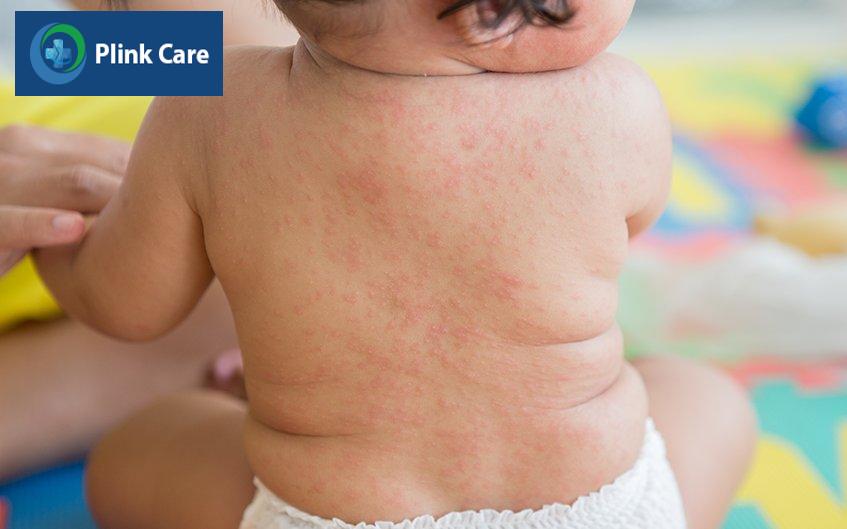 Phát ban là triệu chứng đặc trưng của trẻ