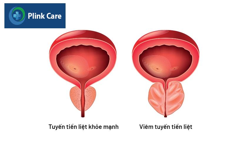 sơ lược về bệnh viêm tuyến tiền liệt mạn 