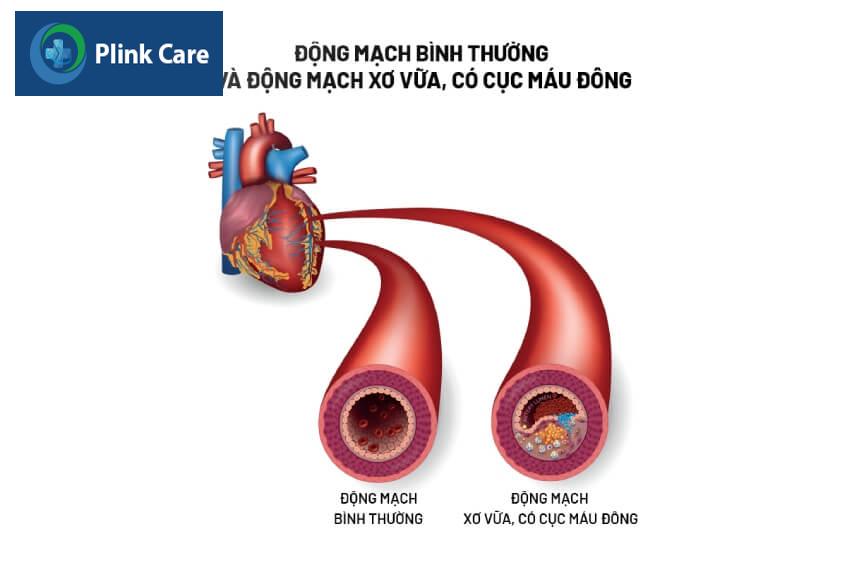 tắc nghẽn mạch máu não