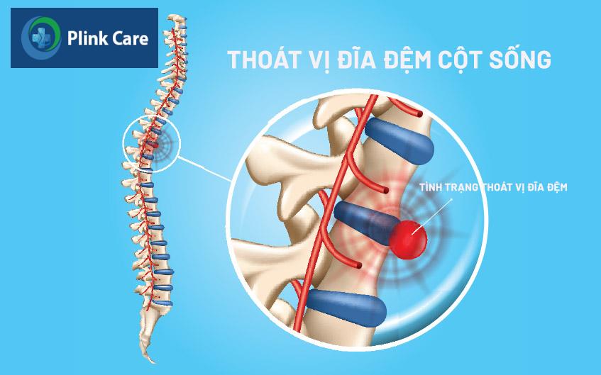 thoát vị đĩa đệm cột sống