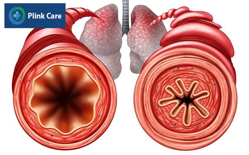 tiểu phế quản khỏe mạnh và bị nhiễm bệnh