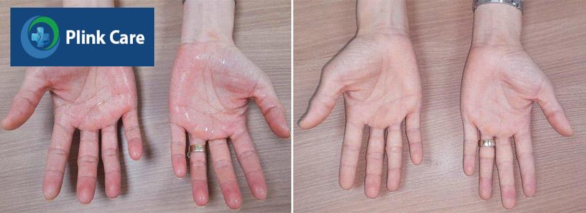 tình trạng đổ mồ hôi ở tay