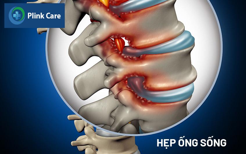 tình trạng hẹp ống sống