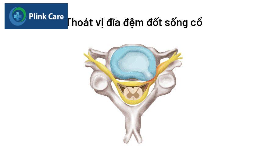 tình trạng thoát vị đĩa đệm đốt sống cổ