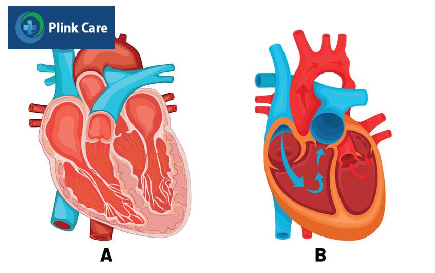 trái tim bị còn ống động mạch