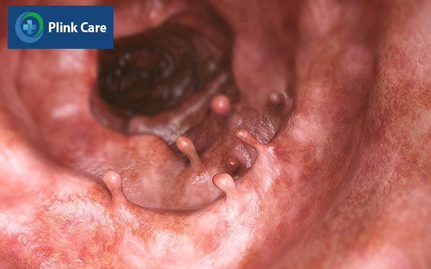 triệu chứng polyp trực tràng