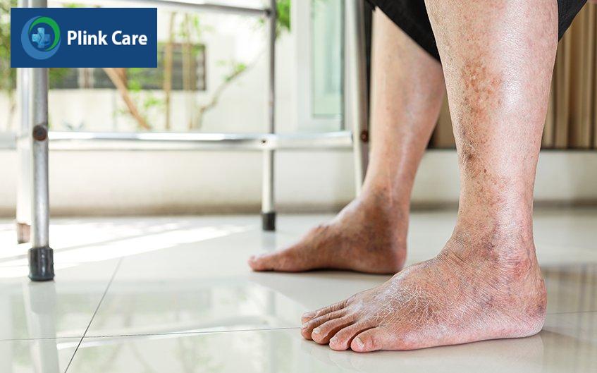 triệu chứng viêm cầu thận mạn tính
