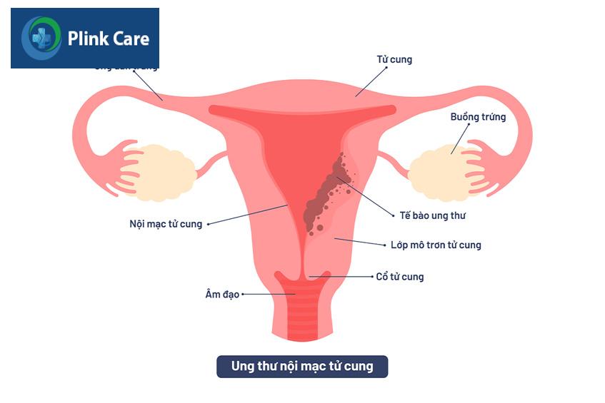 ung thư nội mạc tử cung