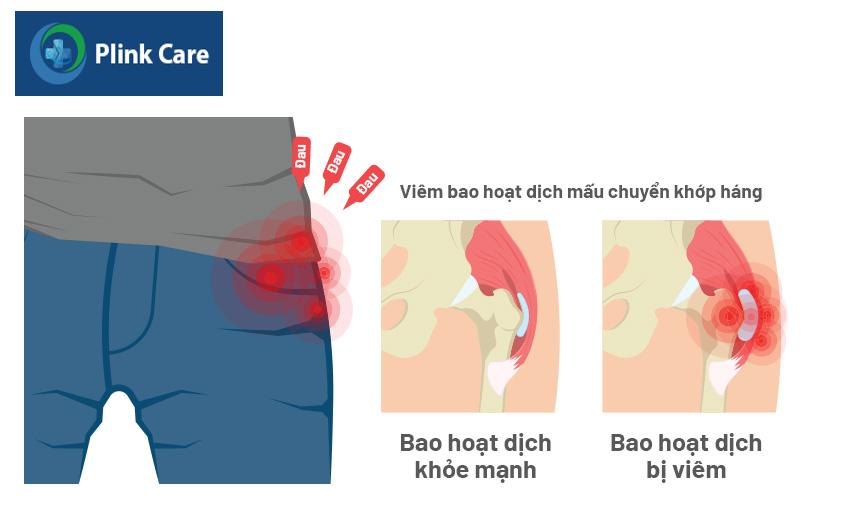 viêm bao hoạt dịch mấu chuyển khớp háng