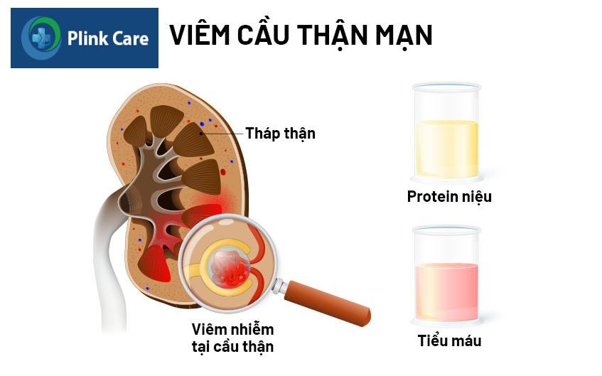 viêm cầu thận mạn là gì