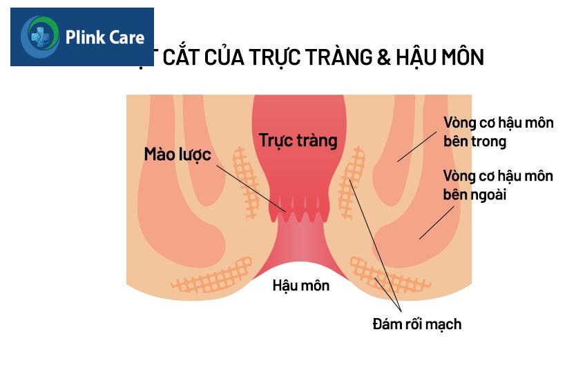 viêm hậu môn là gì