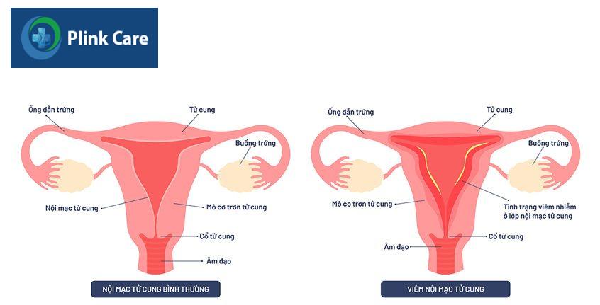 viêm nhiễm lớp nội mạc tử cung