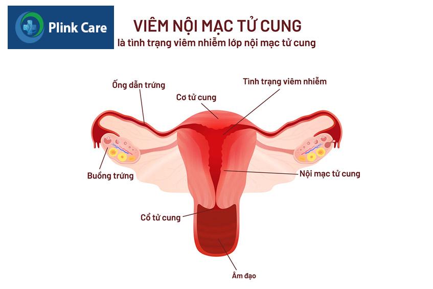 viêm nội mạc tử cung ở phụ nữ sau sinh