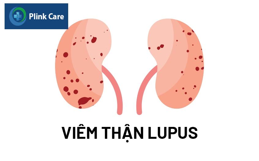 viêm thận lupus là gì