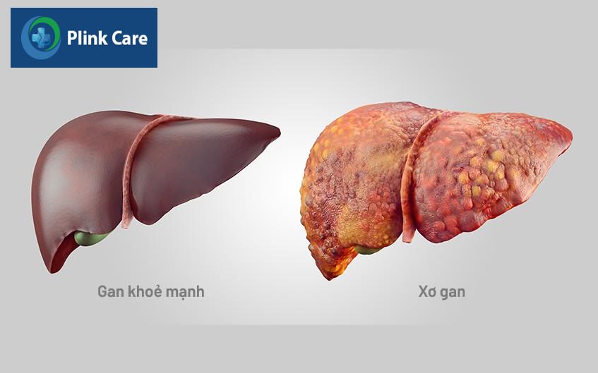 xơ gan giai đoạn mất bù
