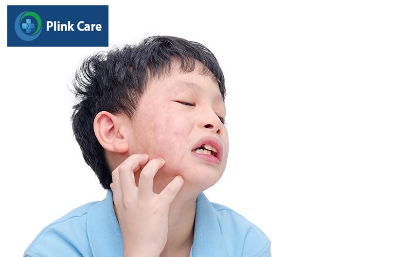 Tuyến mang tai của trẻ bị quai bị sưng to gây đau nhức