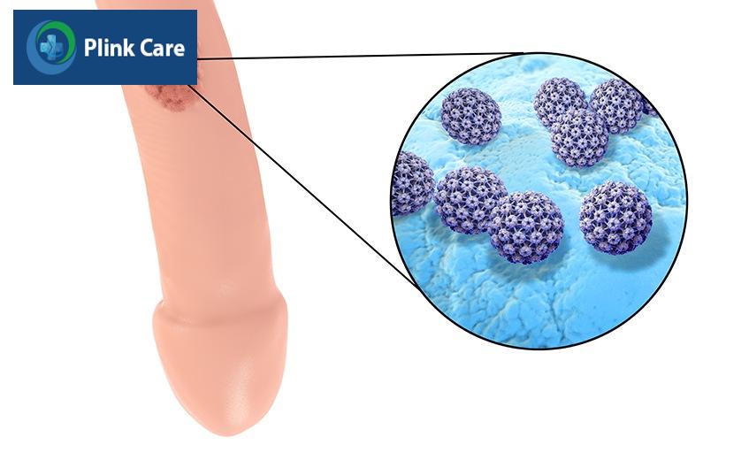 bệnh sùi mào gà có nguy hiểm không