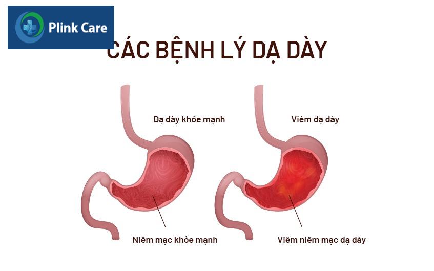 bệnh viêm dạ dày