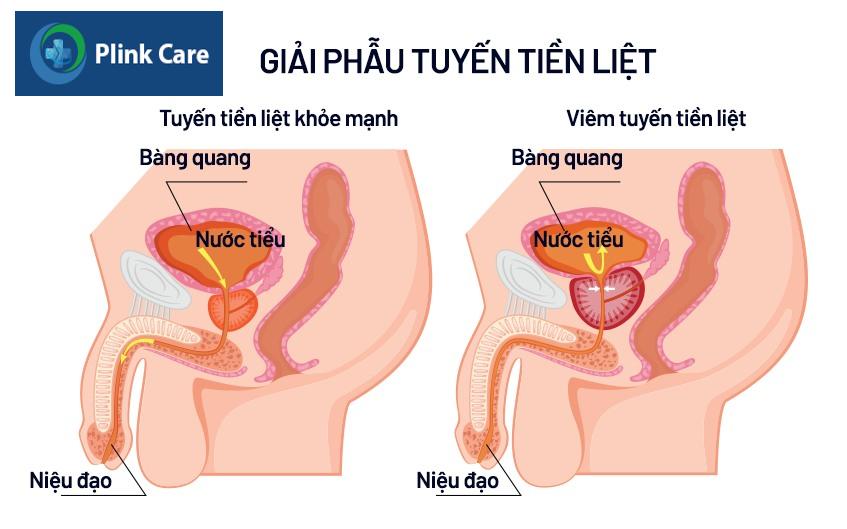 bệnh viêm tuyến tiền liệt có nguy hiểm không