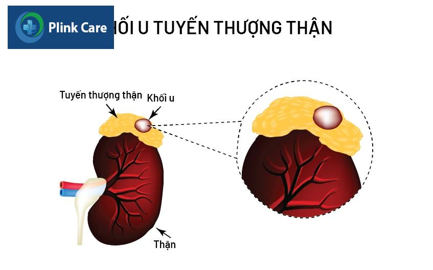 bướu và ung thư