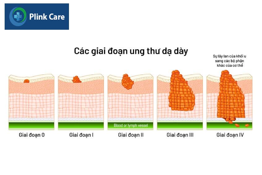 các giai đoạn ung thư dạ dày