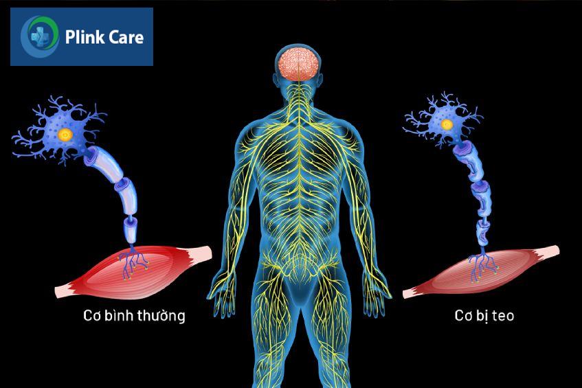 cách phòng ngừa bệnh teo cơ do đái tháo đường