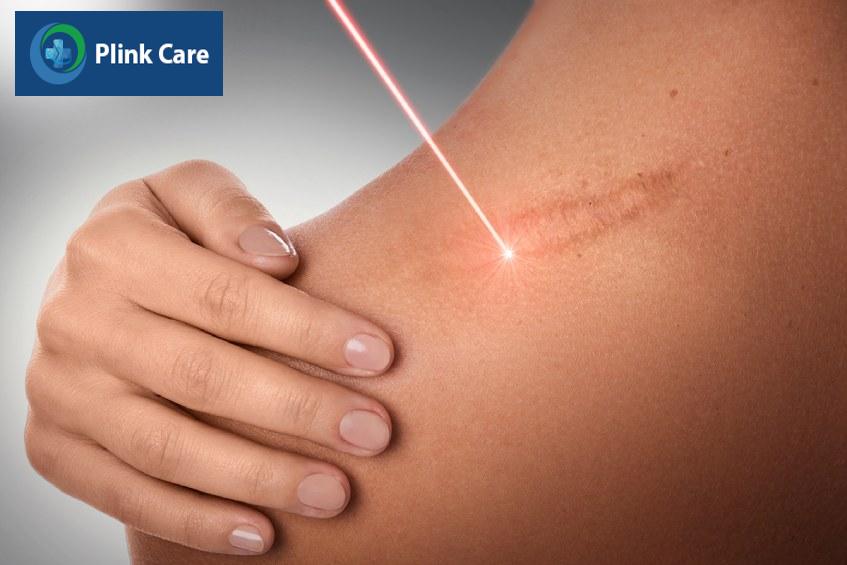 chữa sẹo lồi bằng laser