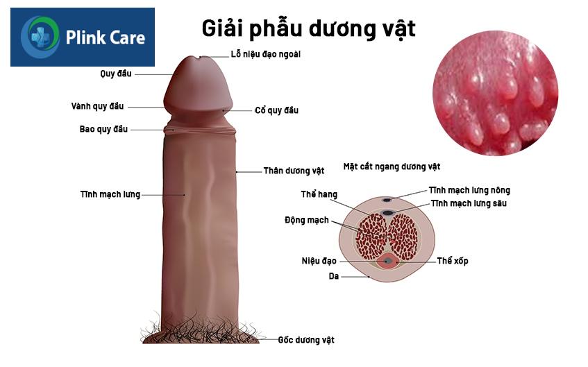chuỗi hạt ngọc dương vật là bệnh gì