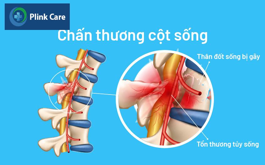 cột sống bị tổn thương