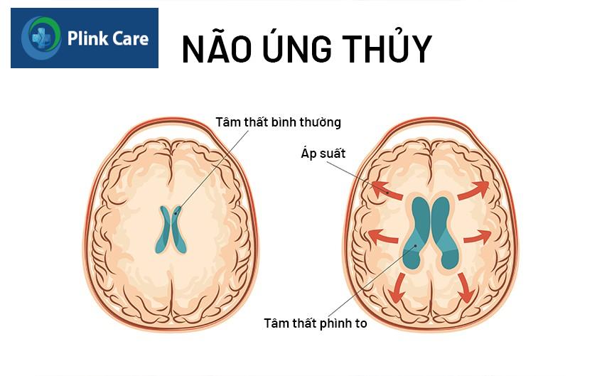 Dịch não tủy bị ứ đọng trong tâm thất, gây áp lực lên não