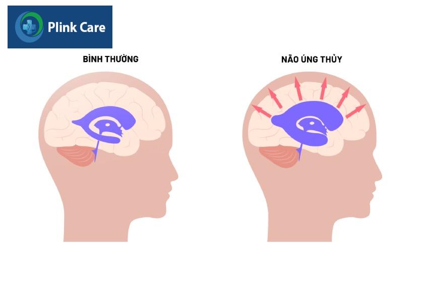 Dịch não tủy tích tụ bên trong não thất làm tăng áp lực lên nội sọ