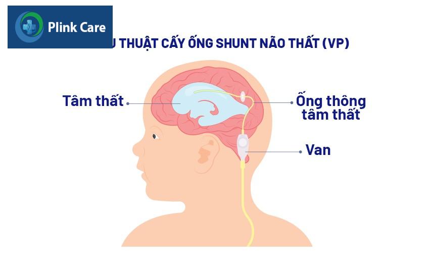 điều trị bằng phương pháp cấy ống shunt não thất