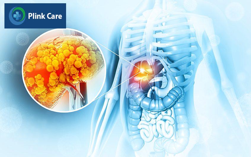 gan nhiễm mỡ cấp độ 2