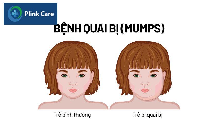 Hai bên má của trẻ bị quai bị sưng to, không đối xứng