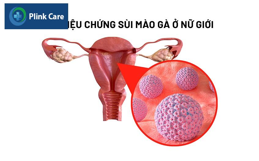 hình ảnh sùi mào gà ở cổ tử cung